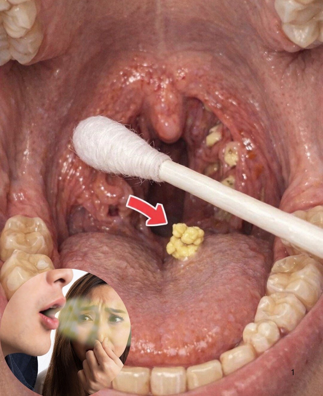 Mauvaise Haleine Tenace Malgré le Brossage ? Les Calculs Amygdaliens Pourraient en Être la Cause