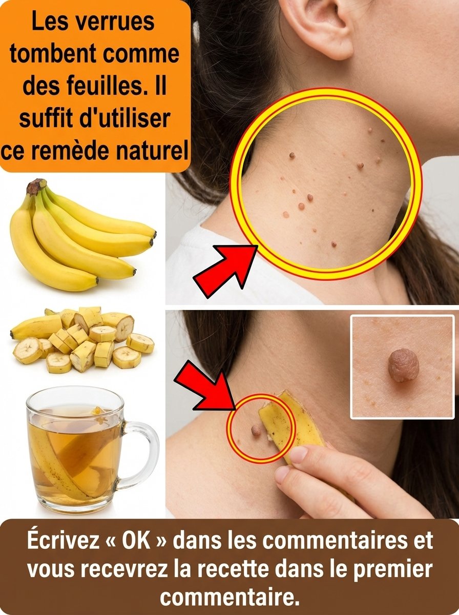 Le Secret Anti-Verrues Que Personne Ne Vous Dit : 3 Recettes Miraculeuses Avec La Peau de Banane Pour Une Peau Parfaite !