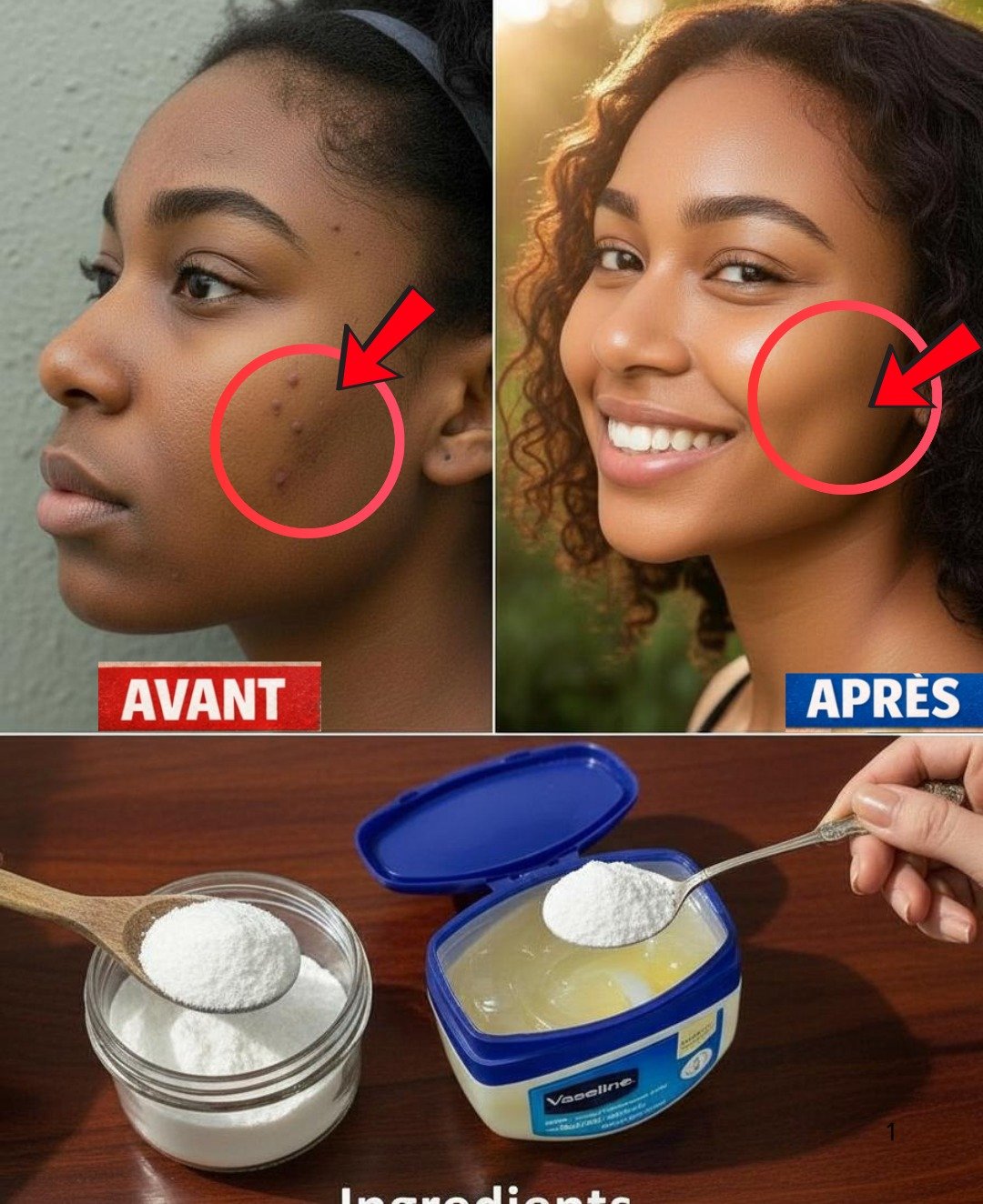 Éliminer les Acrochordons Naturellement en une Nuit : Le Guide Complet de la Méthode à la Vaseline