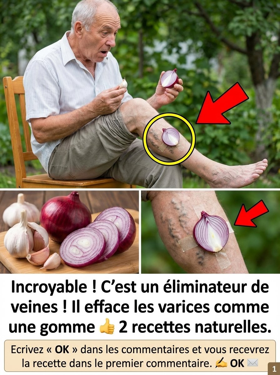 Varices : Le Piège des Remèdes Maison Révélé ! Ce Que VOUS DEVEZ Absolument Savoir AVANT d'Agir