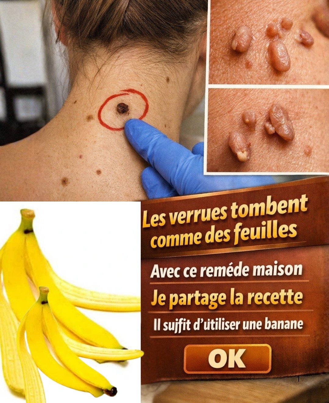 La peau de banane et les remèdes naturels pour le traitement des verrues