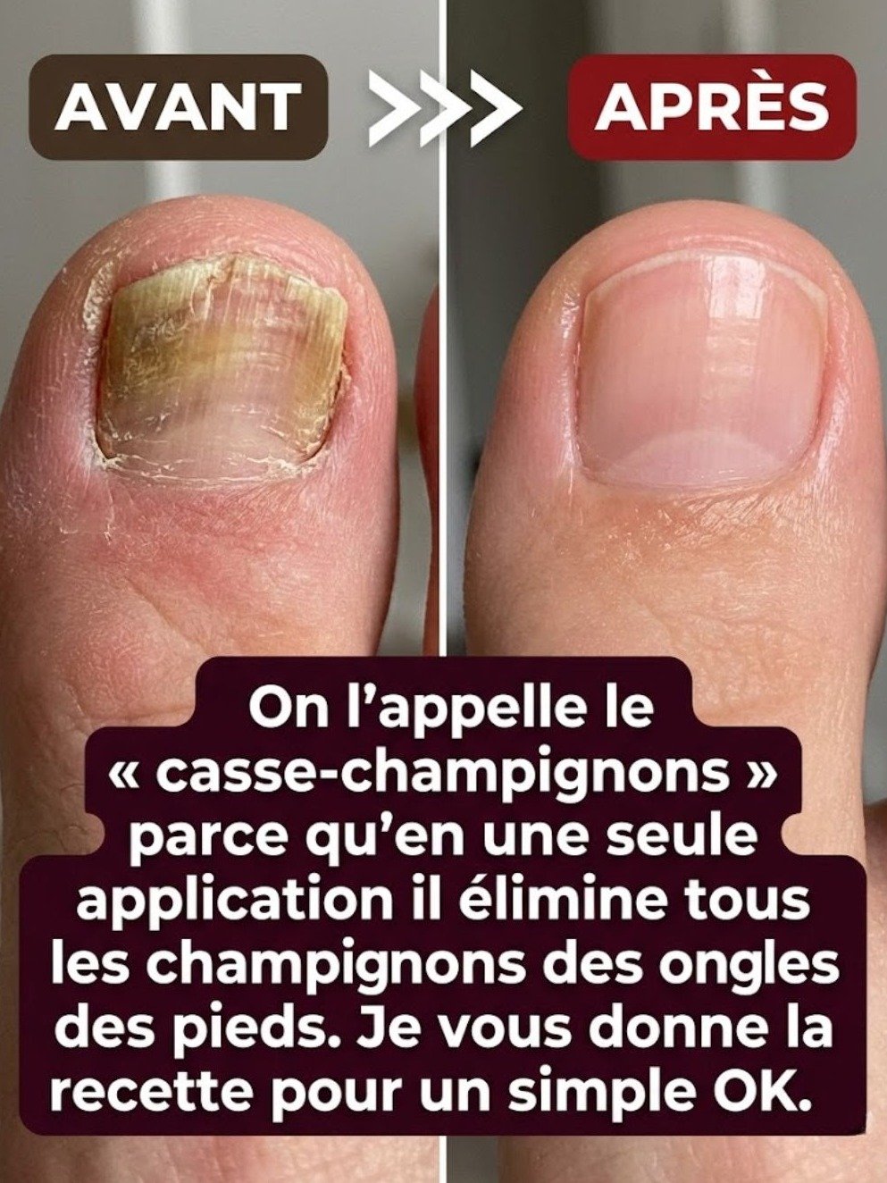 Mycose des Ongles : Le SECRET Naturel à l'Origan qui va TRANSFORMER vos Pieds en 3 Semaines (Ne Manquez Pas Ça !)