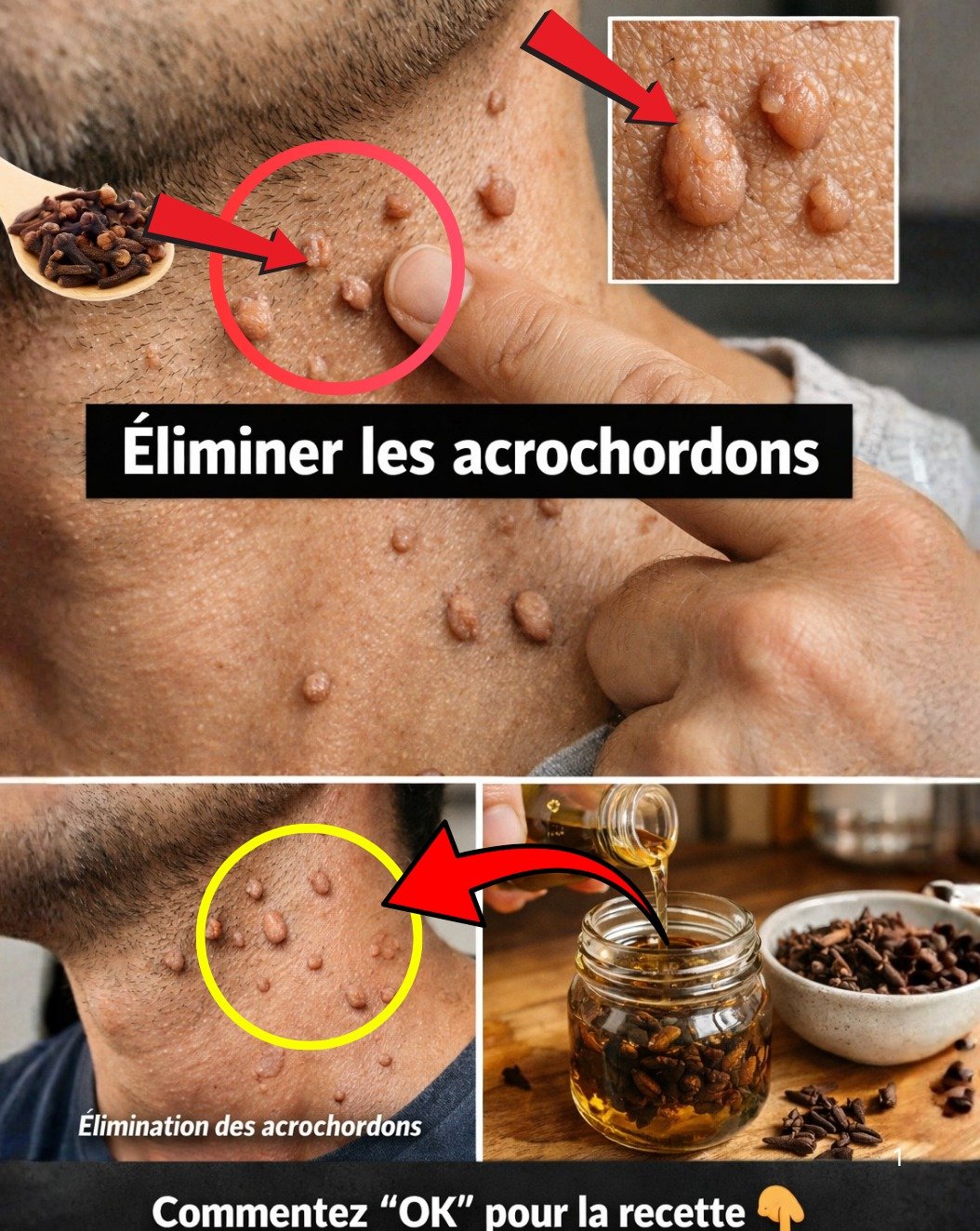 Adieu les Acrochordons ! 3 Remèdes Maison Incroyables pour une Peau Lisse (Le N°2 est Bluffant)