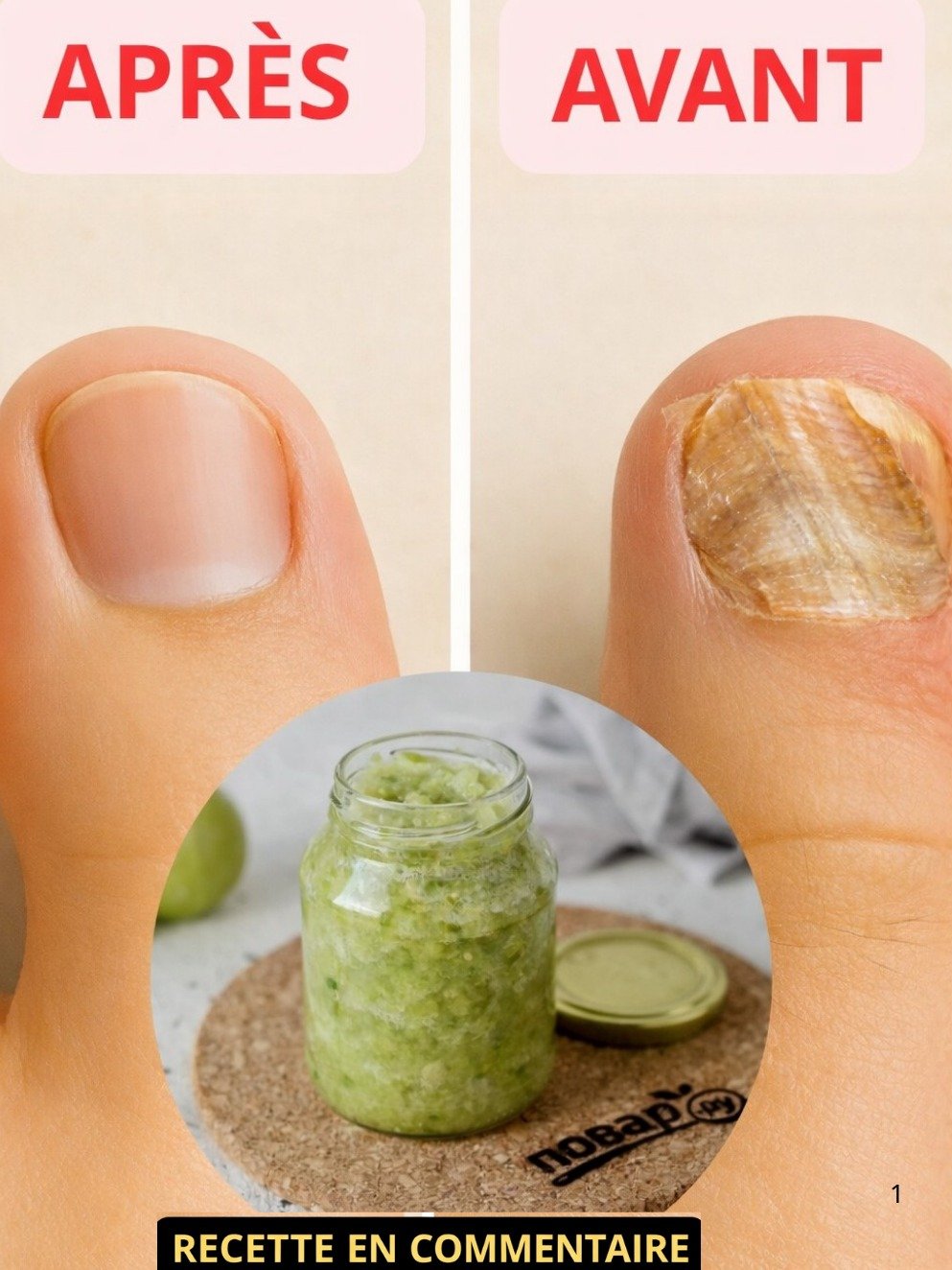 🔴 URGENT : Éradiquez Définitivement les Mycoses des Pieds et Ongles avec CE Remède Maison (Vos Pieds Ne Seront Plus Jamais Les Mêmes) !