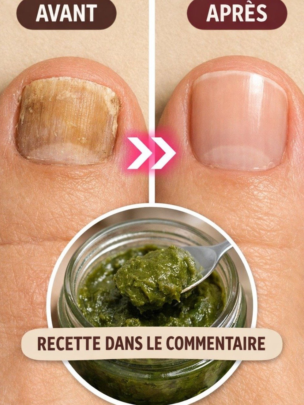 Le Secret Anti-Champignons Révélé : Dites ADIEU aux Pieds et Ongles Abîmés avec ce Remède Naturel Infaillible !