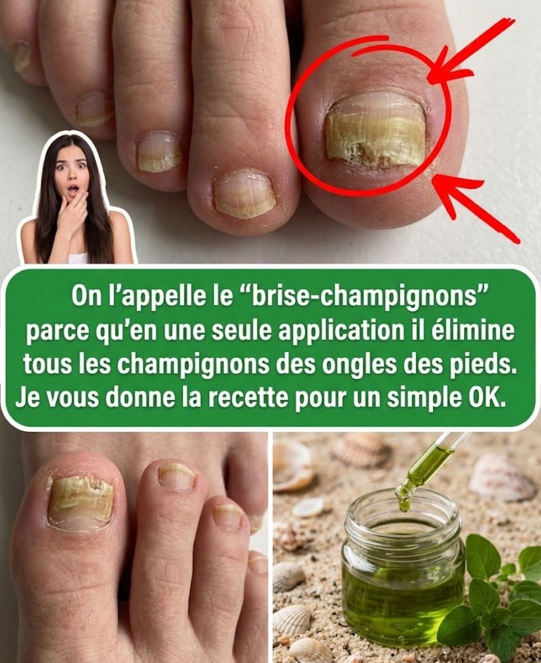 Éradiquez la mycose des ongles : le pouvoir de l'origan en remèdes naturels