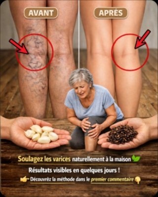 Jambes Lourdes, Varices ? Le Secret Naturel Étonnant de l'Ail et du Clou de Girofle Révélé (Vous Devez Savoir Ça !)