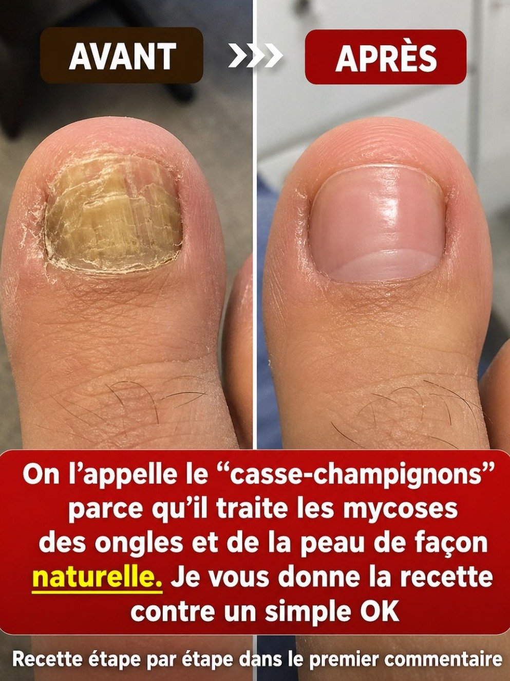Le Secret Oublié des Clous de Girofle : Éliminez les Mycoses des Ongles et de la Peau avec Ces 4 Recettes Maison Révolutionnaires !