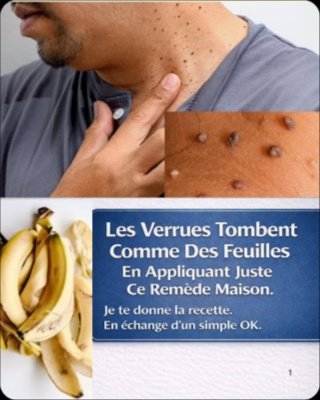 Le Secret Étonnant de la Peau de Banane pour Éliminer les Verrues : 3 Recettes Naturelles à Essayer Absolument !