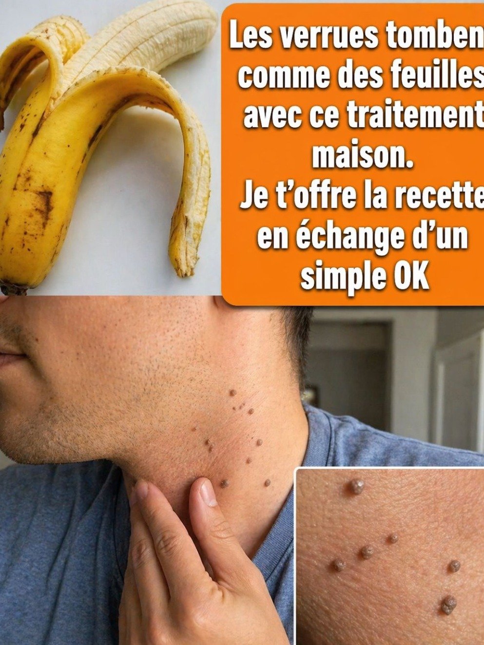 Le Secret Insoupçonné de la Peau de Banane : 5 Remèdes Naturels Étonnants Pour Dire ADIEU aux Verrues !