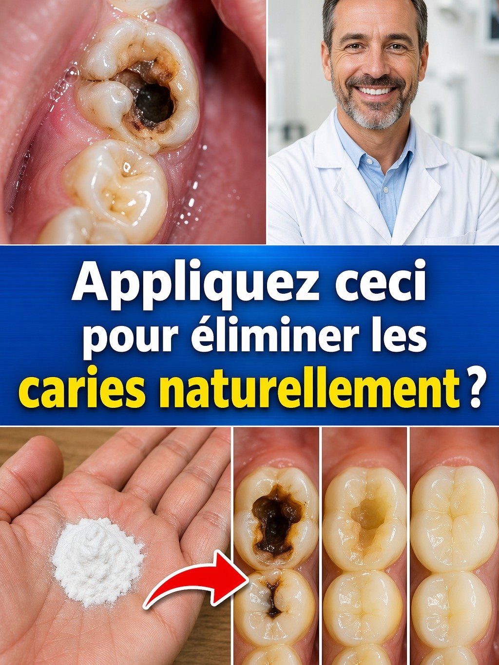 Le Secret Révélé : Dites Adieu aux Caries et Réparez Vos Dents Naturellement en 30 Jours (Sans Dentiste) !