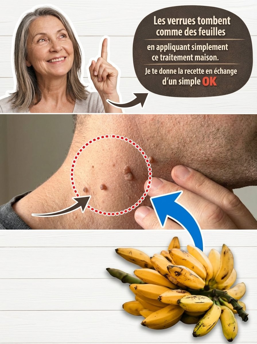 Ne Jetez Plus Vos Peaux de Banane ! 3 Recettes Miracles pour Dire Adieu aux Verrues Rapidement