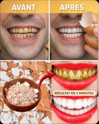 Ne manquez pas ça ! Le secret pour des dents plus blanches en SEULEMENT 5 minutes (méthode naturelle incroyable)