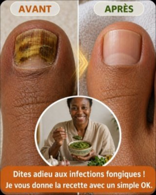 Le Secret ULTIME pour dire ADIEU aux Mycoses des Pieds et Ongles ! 🦶🍄 Ce que PERSONNE ne vous dit pour des pieds impeccables (Ne ratez pas ça !)