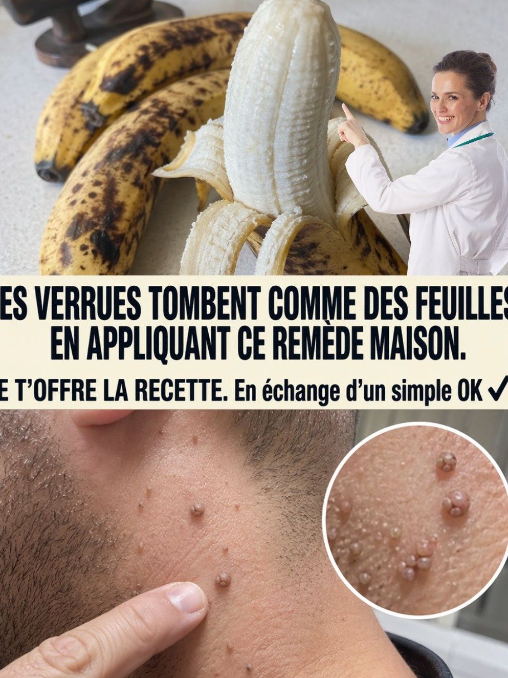 Le Secret Étonnant de la Peau de Banane pour Éliminer les Verrues : Ne Cliquez Pas Si Vous Ne Voulez Pas une Peau Parfaite !