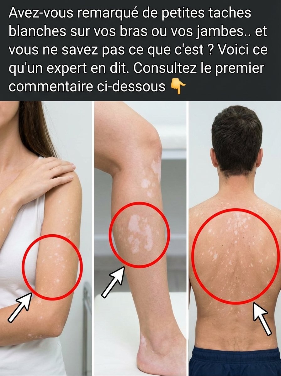 STOP ! Ces Taches Blanches sur Votre Peau Révèlent un Secret (Et Vous Devez Savoir Ça MAINTENANT)