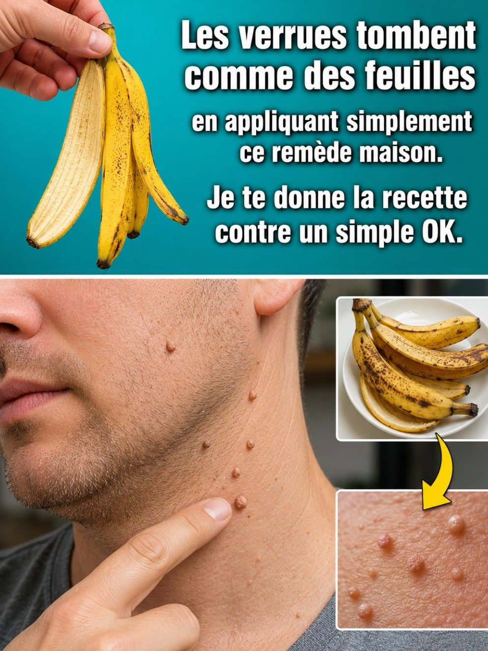 Le Secret Anti-Verrues Révélé : Cette Astuce GRATUITE Fait Tomber Vos Excrescences Comme des Feuilles (Vous l'avez déjà chez vous !)