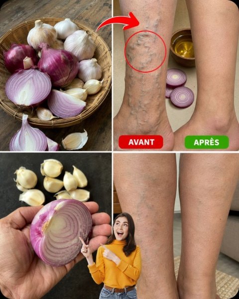 Adieu Varices ! Le Secret Choc Oignon-Ail-Vinaigre Pour Des Jambes Lisses et Légères ENFIN Révélé !