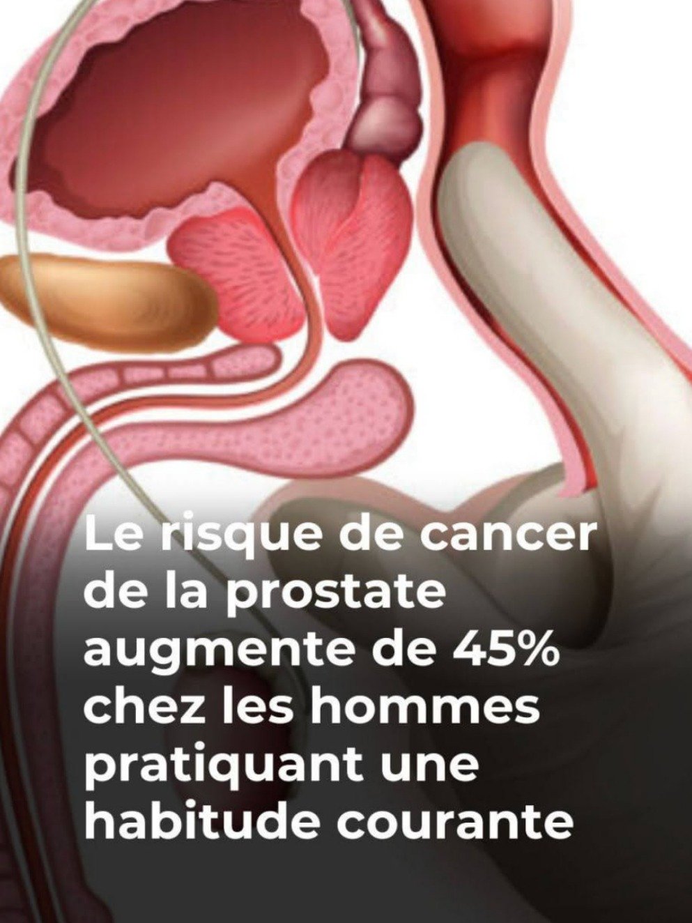 Cancer de la prostate : pourquoi ignorer ce test simple augmente votre risque de 45 %