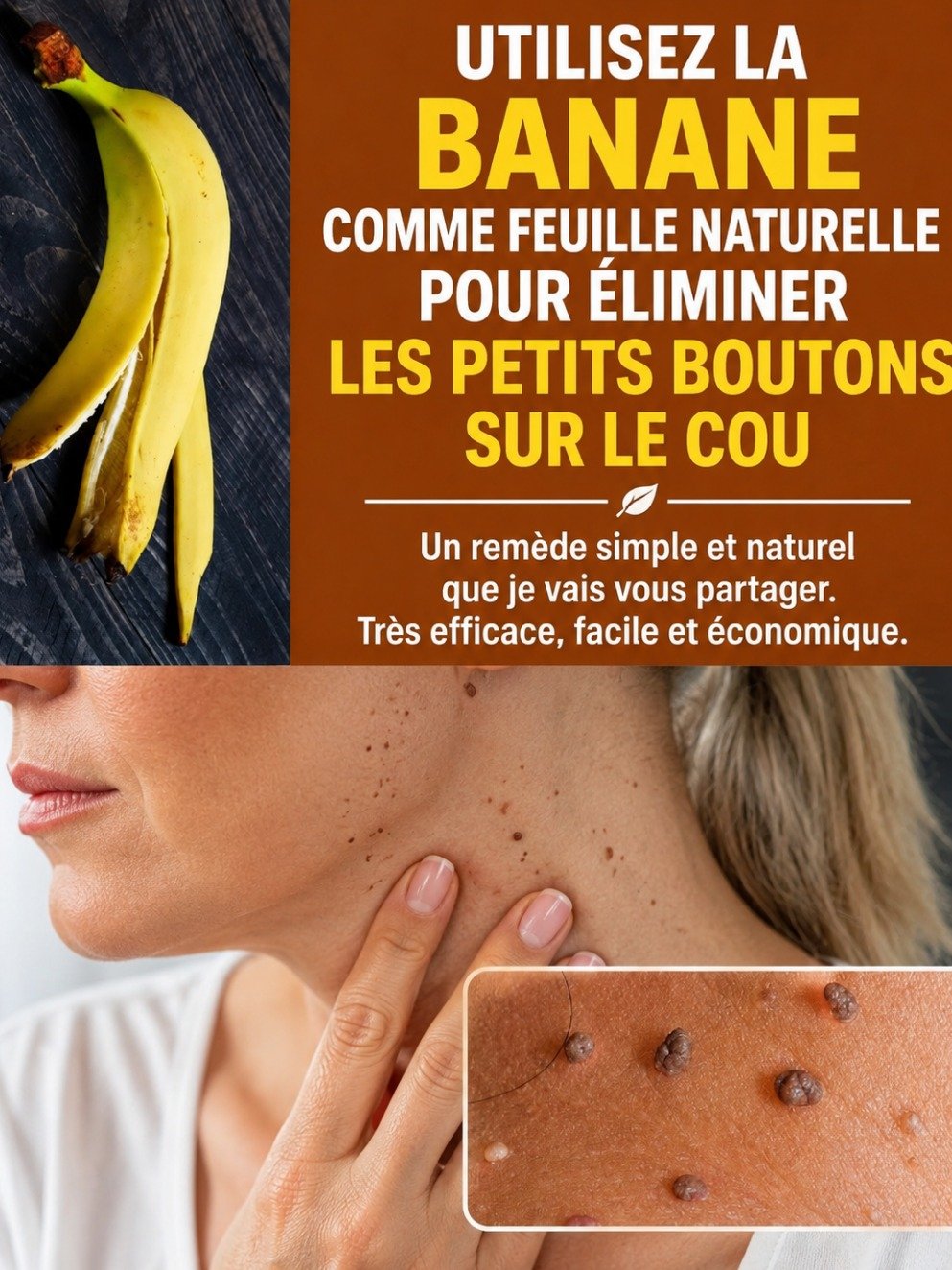 Verrues : Le Secret Viral de la Peau de Banane et 3 Autres Astuces Naturelles à Tester ABSOLUMENT (Avant d'en parler à votre dermato) !