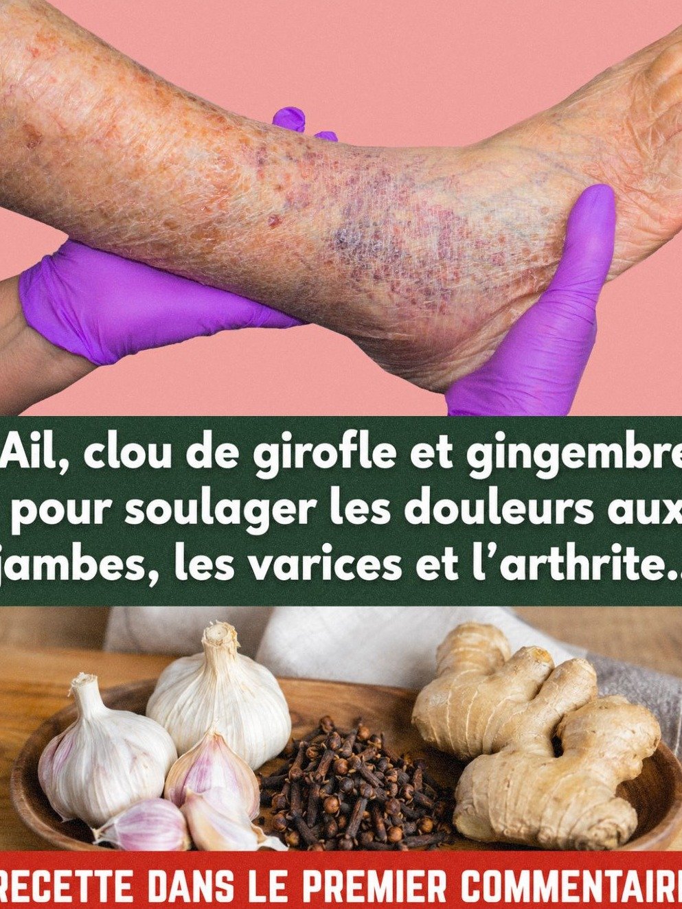 Vous souffrez de varices ? Ce mélange ancestral d'ail et de gingembre va tout changer !