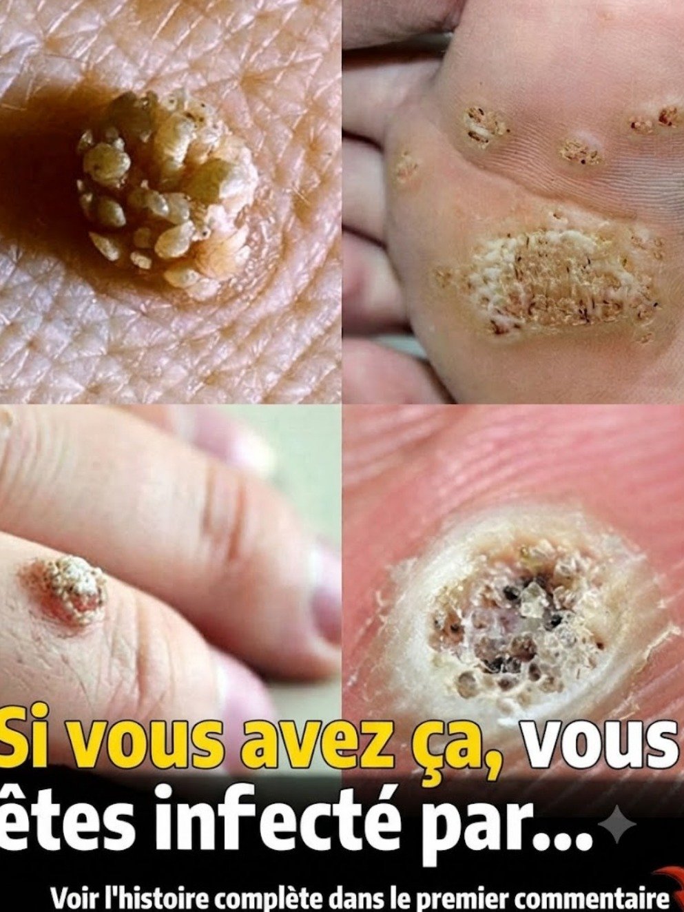 Le guide ULTIME des verrues : 6 types que vous DEVEZ connaître (et comment les ÉLIMINER définitivement)