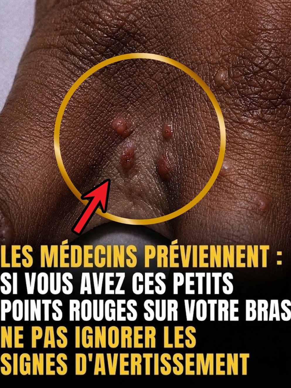 Ces Bosses Rouges Douloureuses VOUS Gâchent la Vie ? Découvrez ENFIN la Vérité sur l'Eczéma Dyshidrotique (et comment Agir MAINTENANT) !